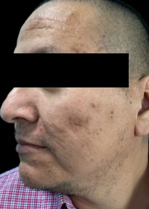 Antes del tratamiento