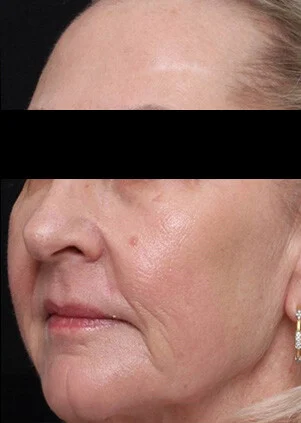 Después del tratamiento