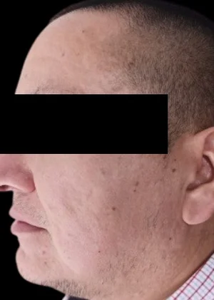 Después del tratamiento