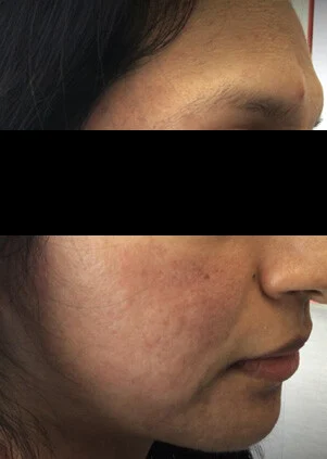 Después del tratamiento