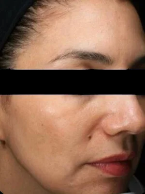 Después del tratamiento