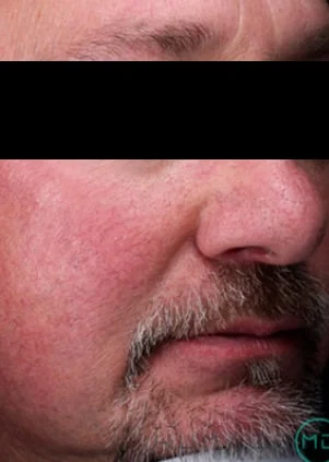 Antes del tratamiento