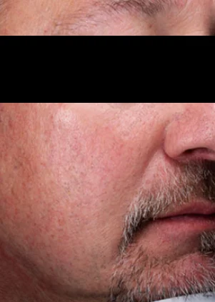 Después del tratamiento