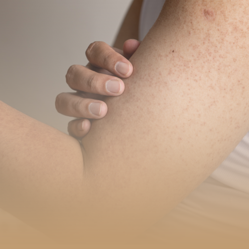 Tratamiento Queratosis